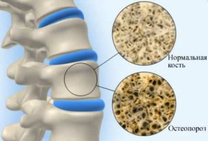 нормальный скелет и остеопороз