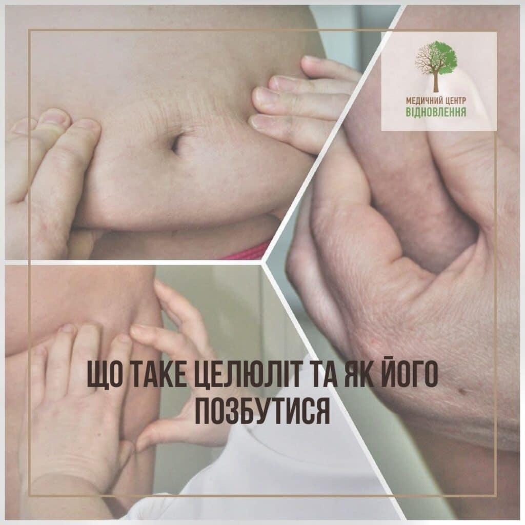 антицелюлітна програма
