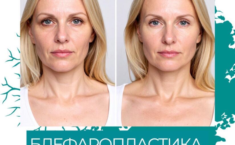 Блефаропластика у клініці «Відновлення»: чому важливо мати вибір!