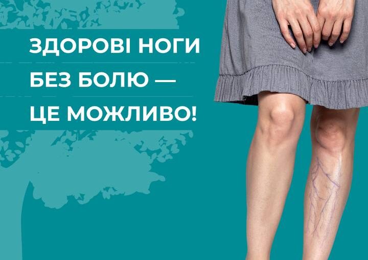 Симптоми, які не можна ігнорувати при варикозі!