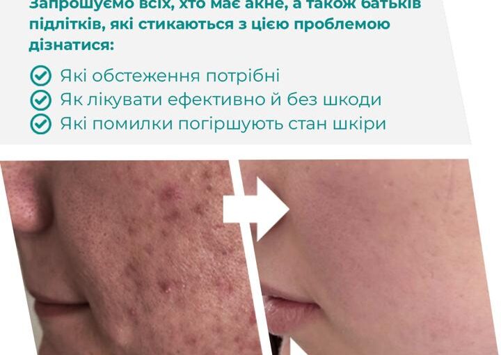 ШКОЛА АКНЕ — для дорослих і підлітків